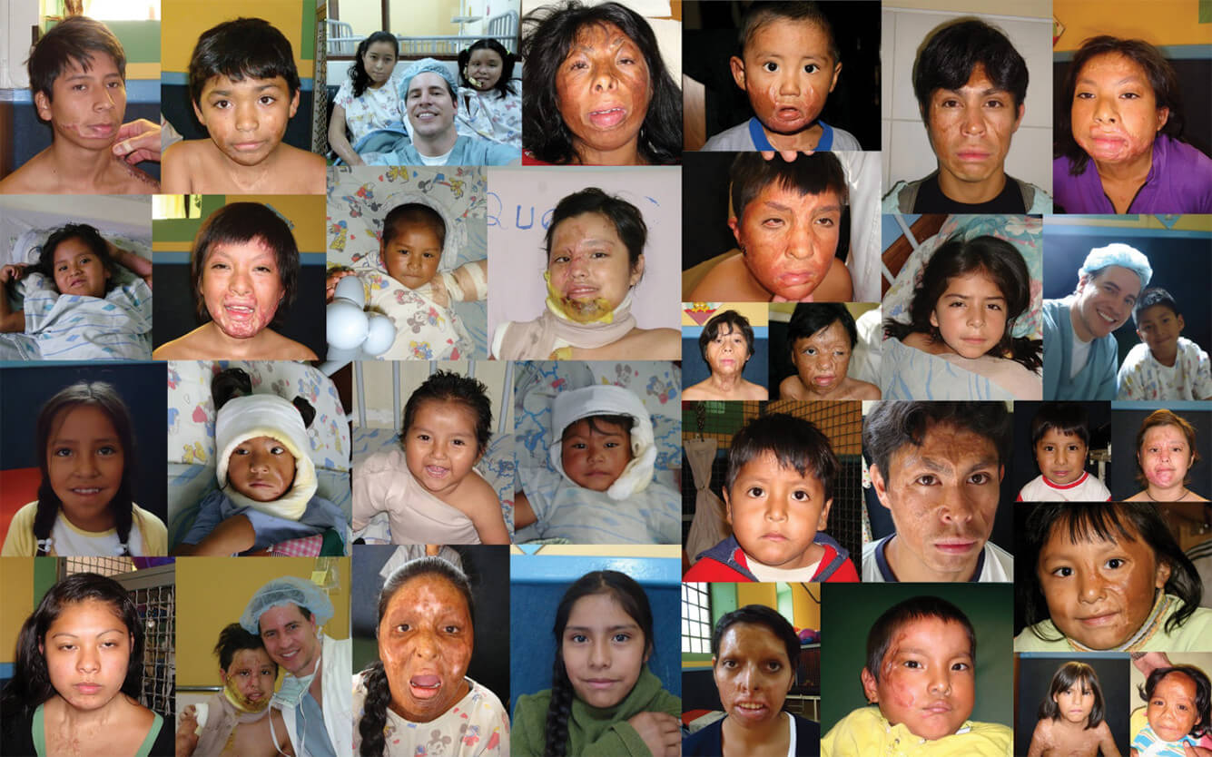 Collage of Dr. Stoeckel's young plastic and reconstructive surgery patients in Bolivia