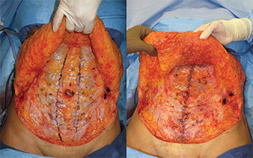 Operative photos demonstrating the extent of a rectus diastasis marked with blue dye on the left and after plication of the muscles on the right