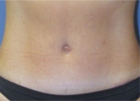 Operative photos demonstrating the extent of a rectus diastasis marked with blue dye on the left and after plication of the muscles on the right
