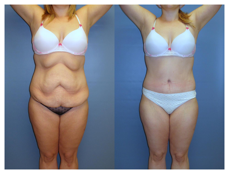 tummy tuck before and after at wake plastic surgery cary nc