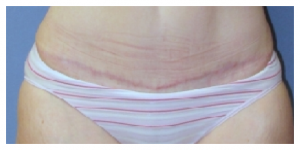 Typical tummy tuck scar after four months of healing