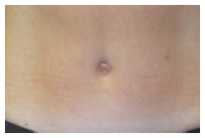 Typical belly button appearance using Dr. Stoeckel’s technique for closure