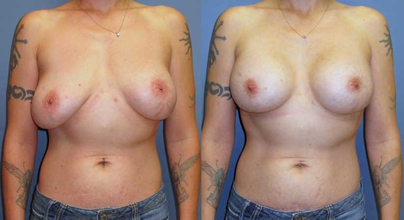Before and After: Subglandular implants on the left. Implant exchange with pocket revision and change to a submuscular position on the right.
