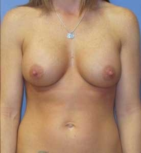 breast augmentation comparison at wake plastic surgery cary nc