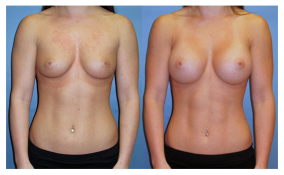 Appropriately enhanced breast size that is proportionate to body frame at wake plastic surgery cary nc