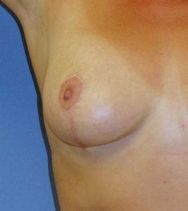 Breast lift scar location