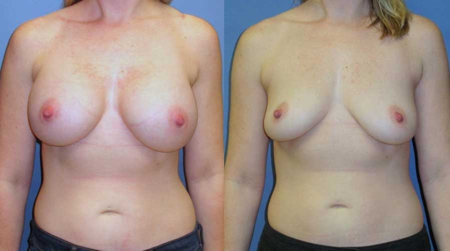 Before and After of Breast Revision at wake plastic surgery cary nc