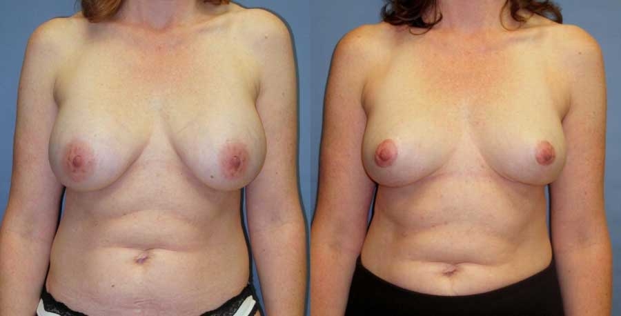 Before and after of breast revision at wake plastic surgery cary nc