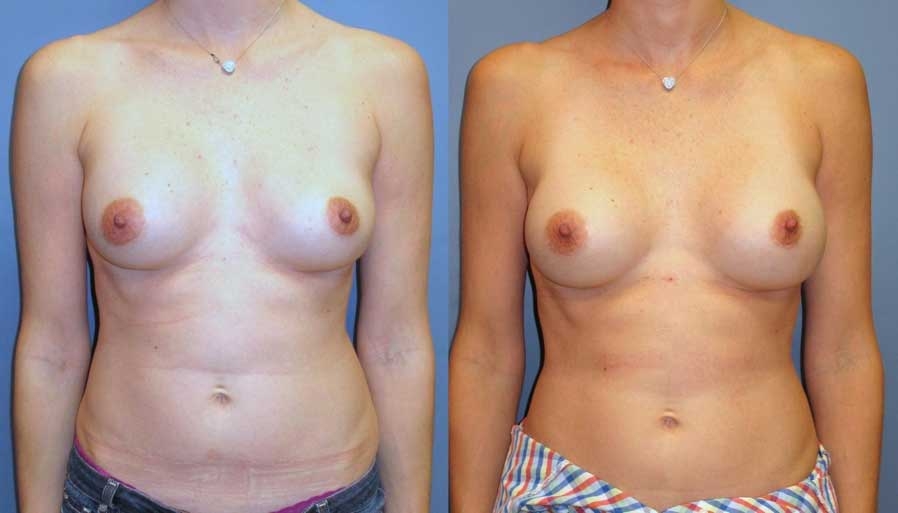 Before and after of breast revision at wake plastic surgery cary nc
