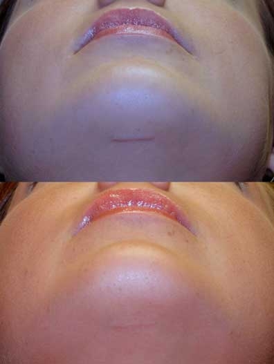 Before and after of chin implant at wake plastic surgery in cary nc