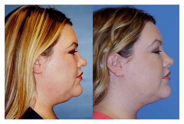 coolsculpting cryotherapy before and after at wake plastic surgery cary nc
