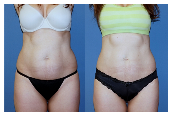 coolsculpting cryotherapy before and after at wake plastic surgery cary nc