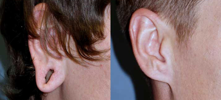 Earlobe Surgery Before and After Photos at wake plastic surgery in cary nc