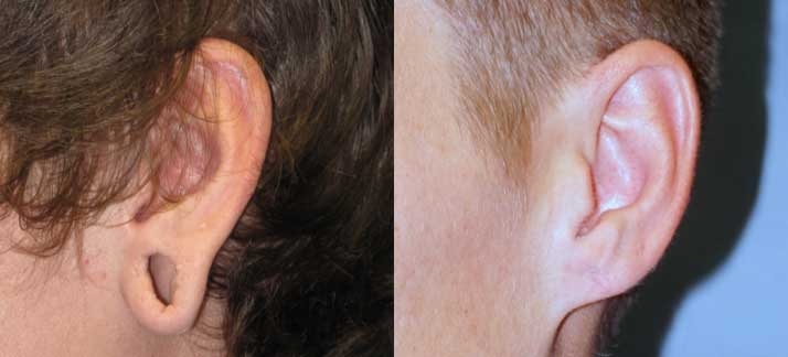 Before and after photos of Ear Surgery at wake plastic surgery in cary nc