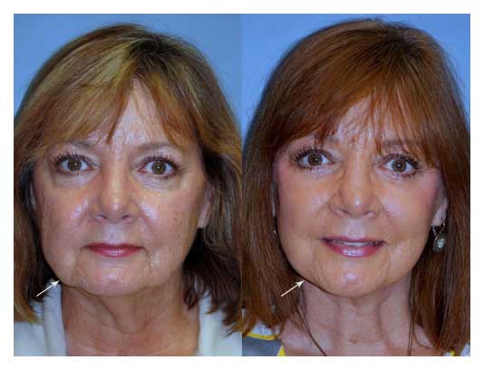 facelift before and after at wake plastic surgery cary nc