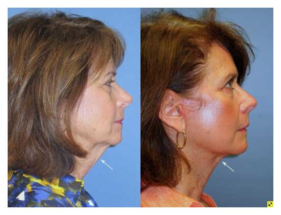 facelift before and after at wake plastic surgery cary nc
