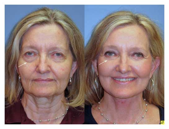 facelift before and after at wake plastic surgery cary nc