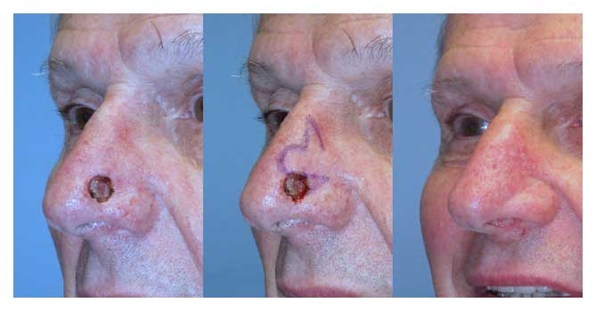 Before and After of Bilobed flap Facial Reconstruction at wake plastic surgery cary nc