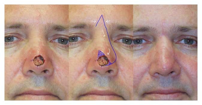 Before and After of Dorsal Nasap Flap Facial Reconstruction at wake plastic surgery cary nc