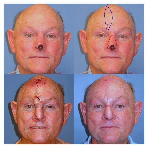 Before and After of Forehead Flap Facial Reconstruction at wake plastic surgery cary nc