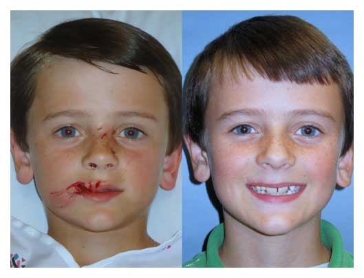 facial trauma before and after at wake plastic surgery in cary nc