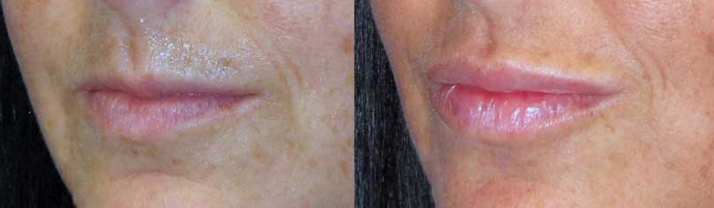 lip augmentation before and after at wake plastic surgery in cary nc