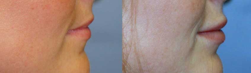 lip augmentation before and after at wake plastic surgery in cary nc