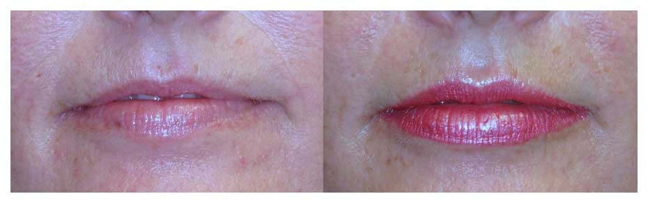lip augmentation before and after at wake plastic surgery in cary nc