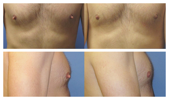 Male Breast Reduction Seattle | Gynecomastia