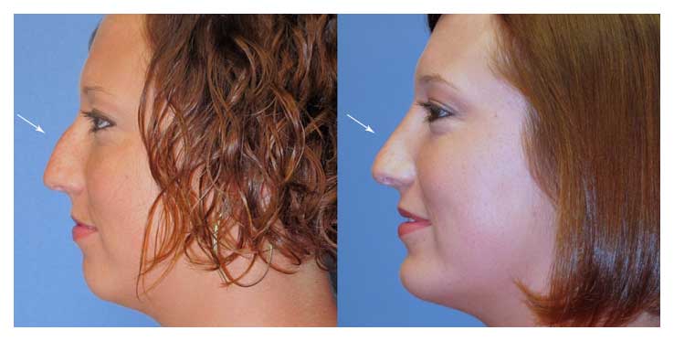 Before and After photo of Rhinoplasty at wake plastic surgery in cary nc