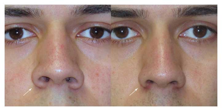 Before and After photo of rhinoplasty at wake plastic surgery in cary nc