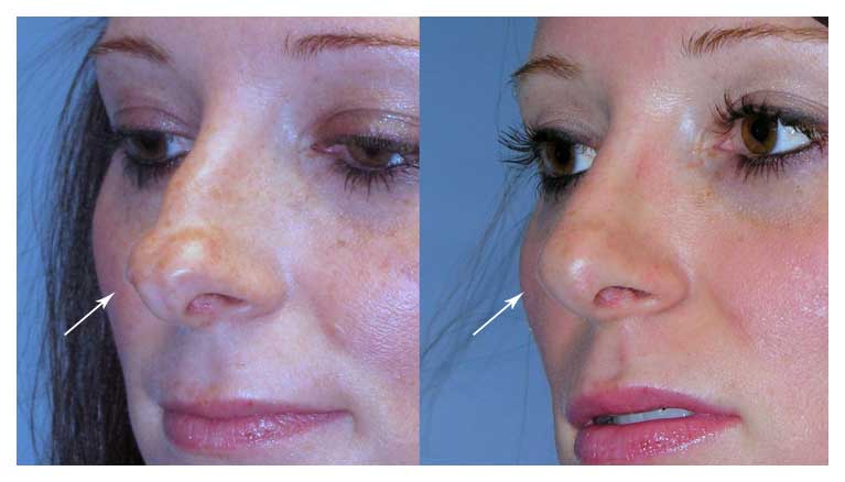 Before and after of splayed tip cartilages at wake plastic surgery in cary nc