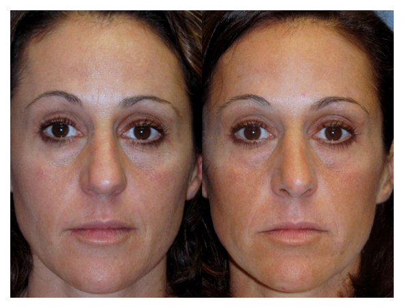 nose surgery before and after at wake plastic surgery in cary nc