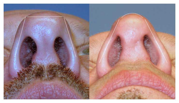 Bulbous tip corrected before and after at wake plastic surgery in cary nc