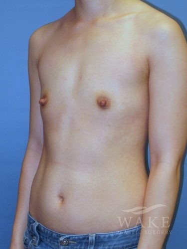 BA oblique before