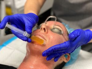 Aesthetician putting PRP serum on to patients face 