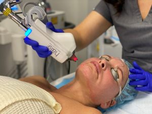 A patients face being treated with the Halo laser by an aesthetician.