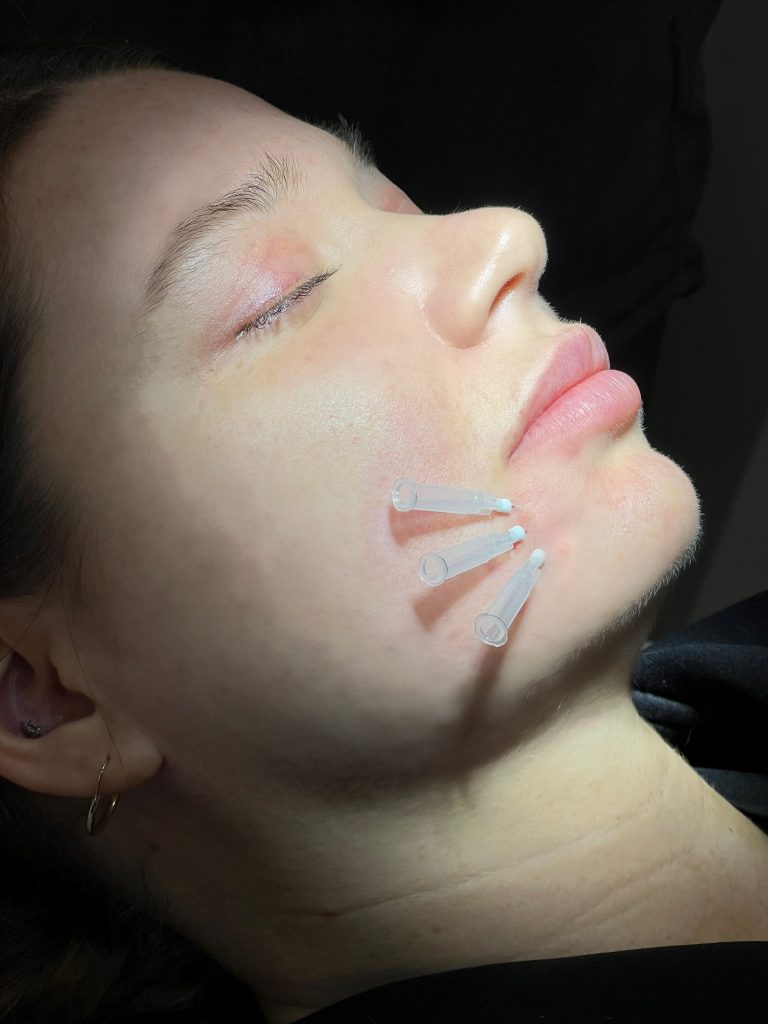 A patient with Smooth PDO Threads inserted in her jawline.