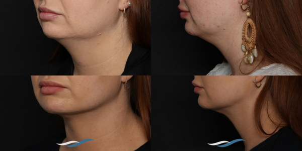 Patient's before and after photos from submental liposuction.