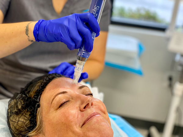 Woman getting skinpen treatment