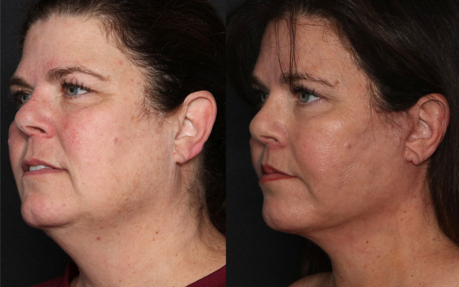 before and after