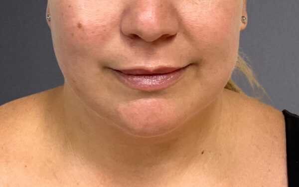 Patient-23 | Before Dermal Filler