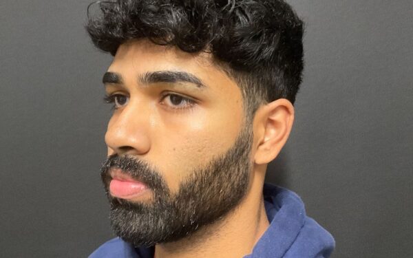 Patient-1 | Before SkinPen - Face, Neck and Chest