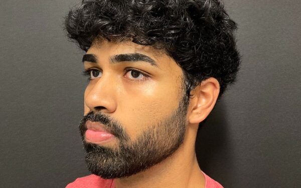 Patient-1 | After SkinPen - Face, Neck and Chest