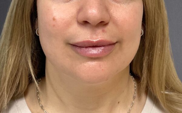 Patient-23 | After Dermal Filler