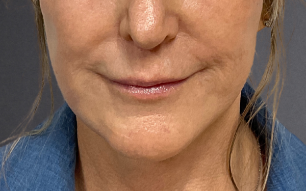 Patient-24 | Before Dermal Filler