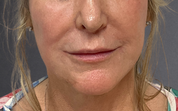 Patient-24 | After Dermal Filler
