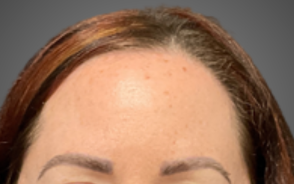 BBL-Patient-4 | Before BBL
