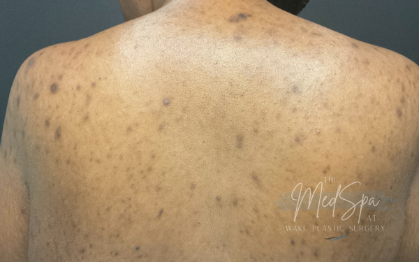 Perfect-Peel-Patient-1 | Before Chemical Peel