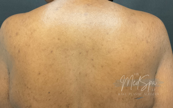 Perfect-Peel-Patient-1 | After Chemical Peel